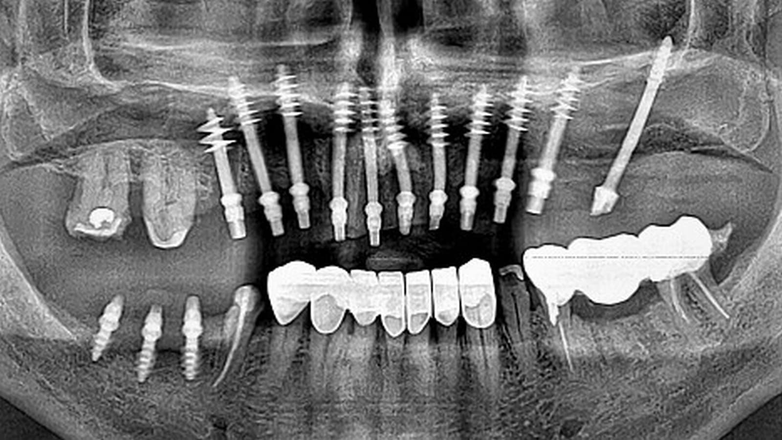 Implantes Cigomáticos monoblock