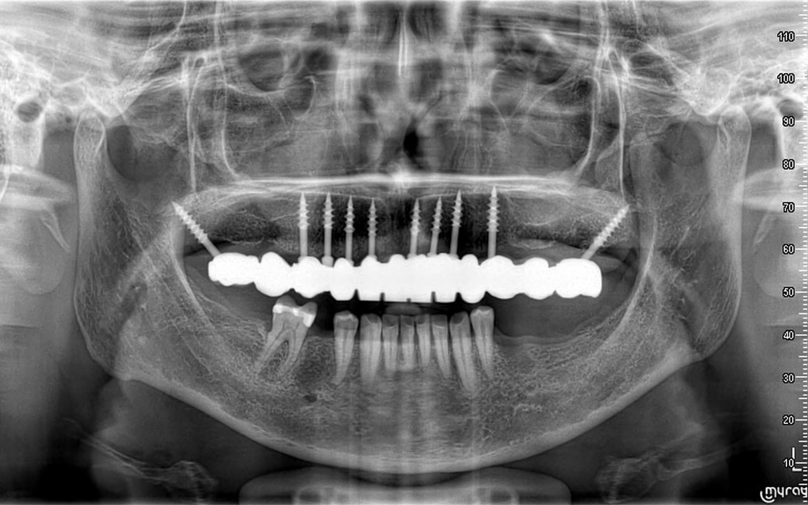 Implantes dentales Basales