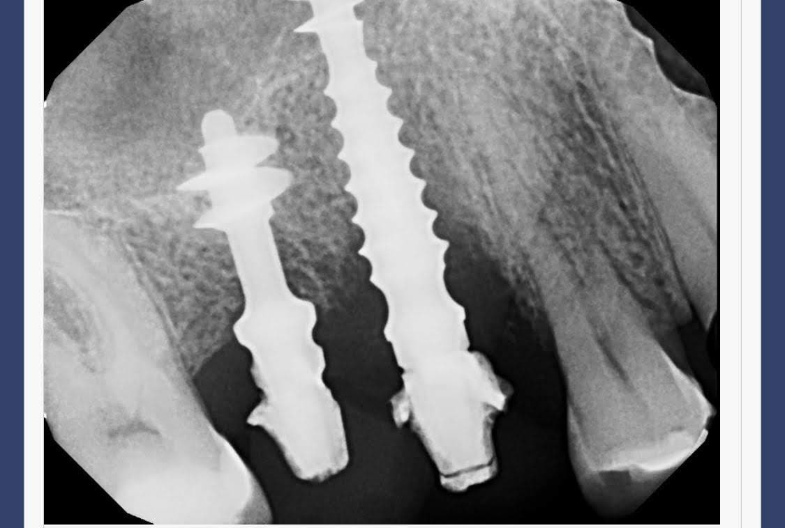 Implantes dentales Compresivos