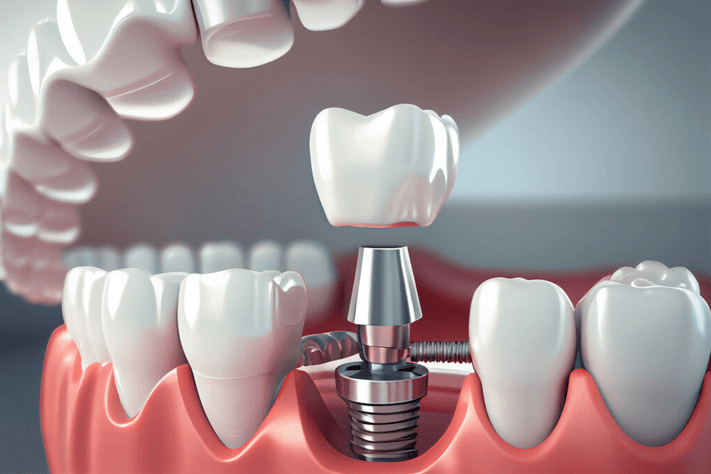 Implantes dentales Bifásicos