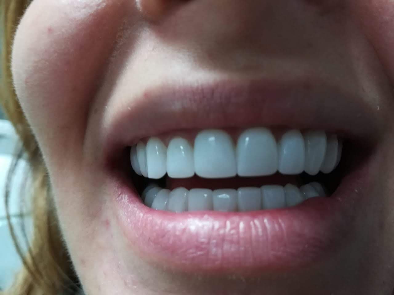 Carillas dentales de Zirconio