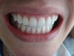 Carillas dentales de Resina