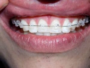 Brackets Cerámicos