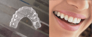 Placas Invisalign