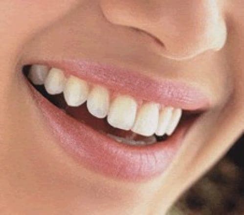 Blanqueamiento Dental