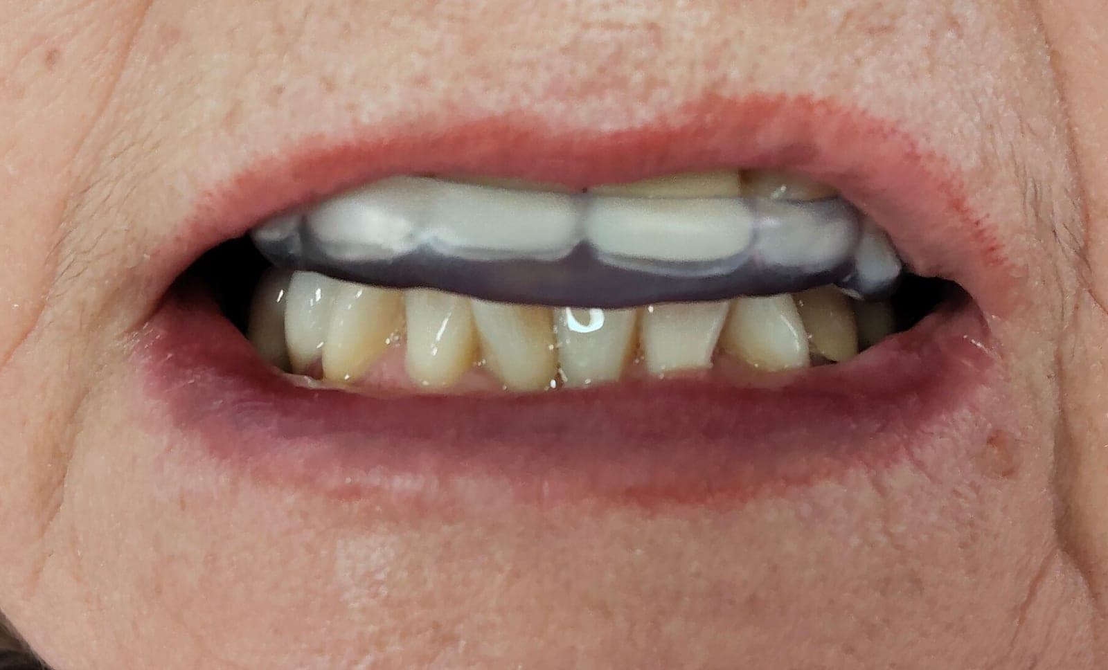 Brackets Autoligado