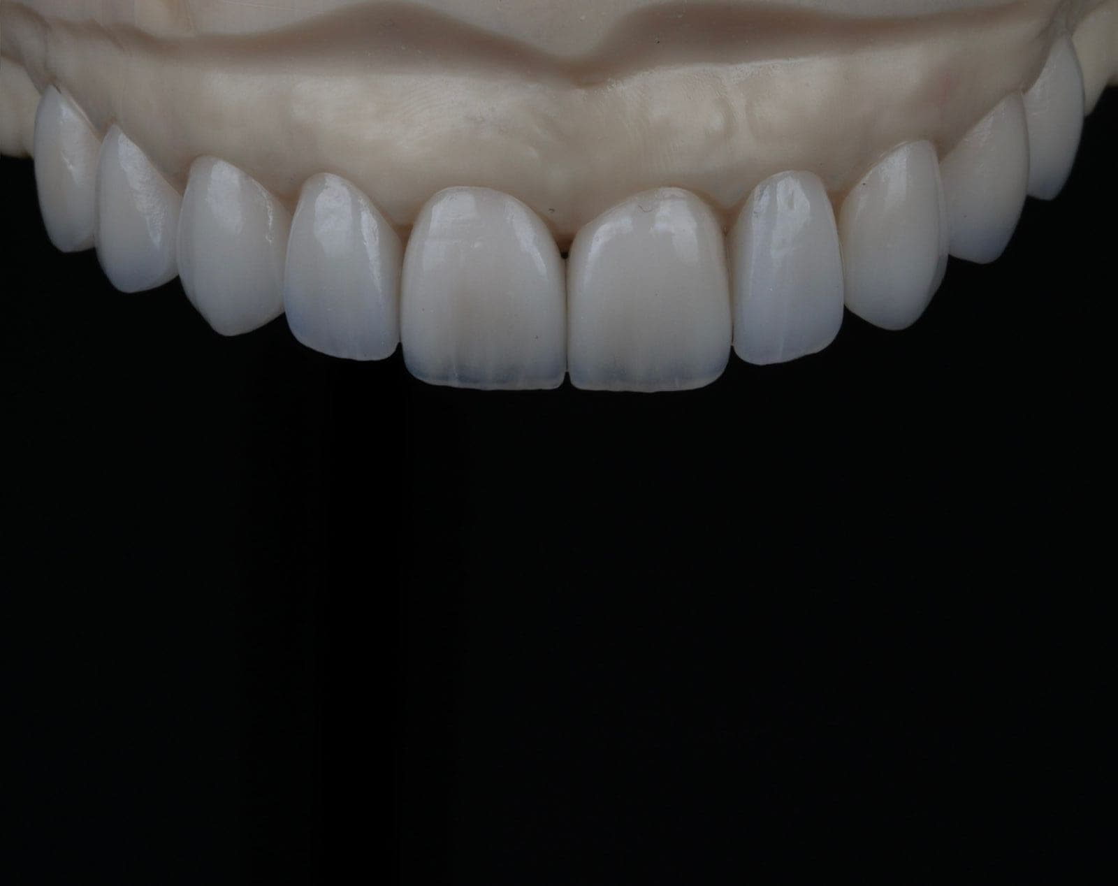 Carillas dentales de Porcelana dental