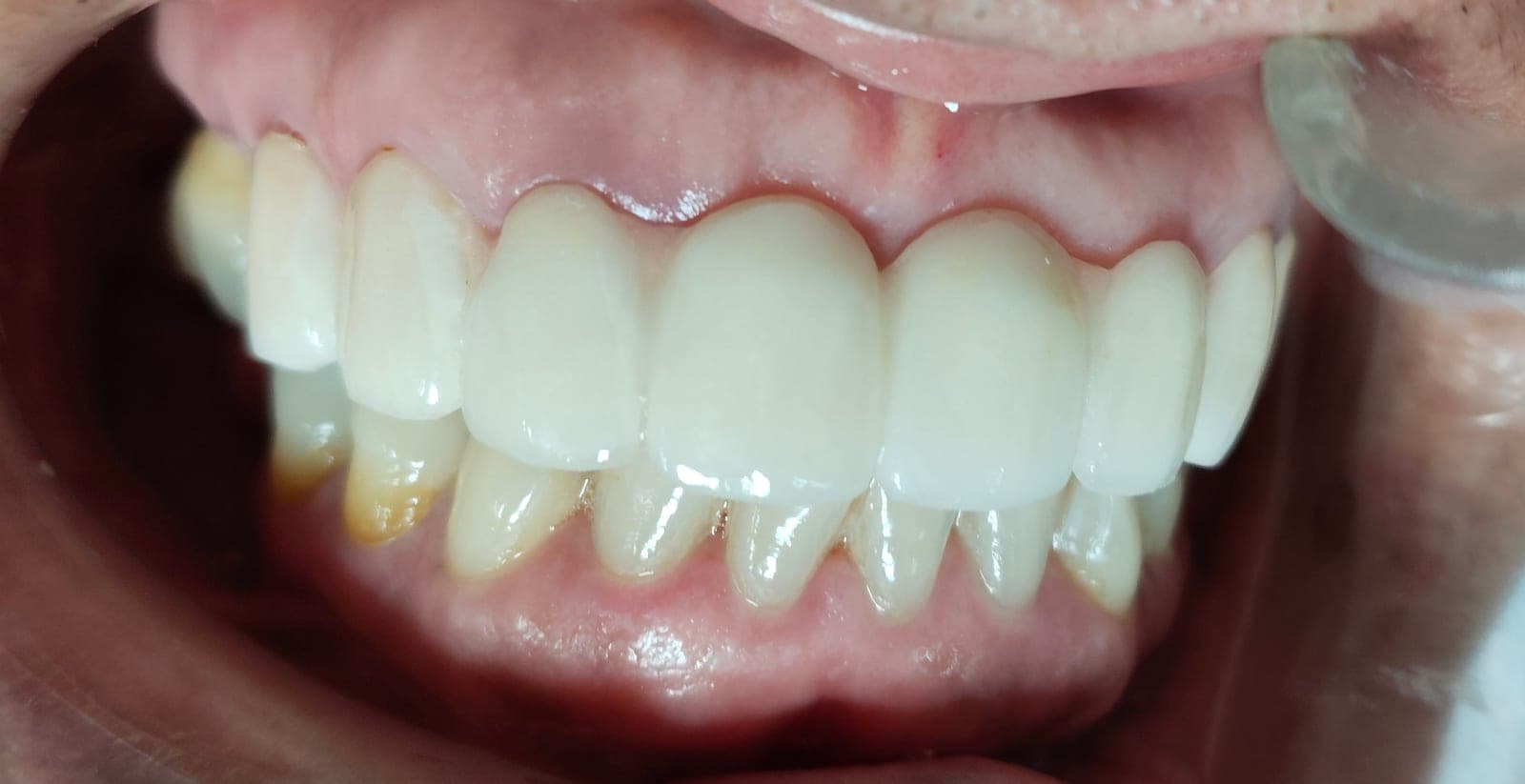 Coronas dentales de Zirconio