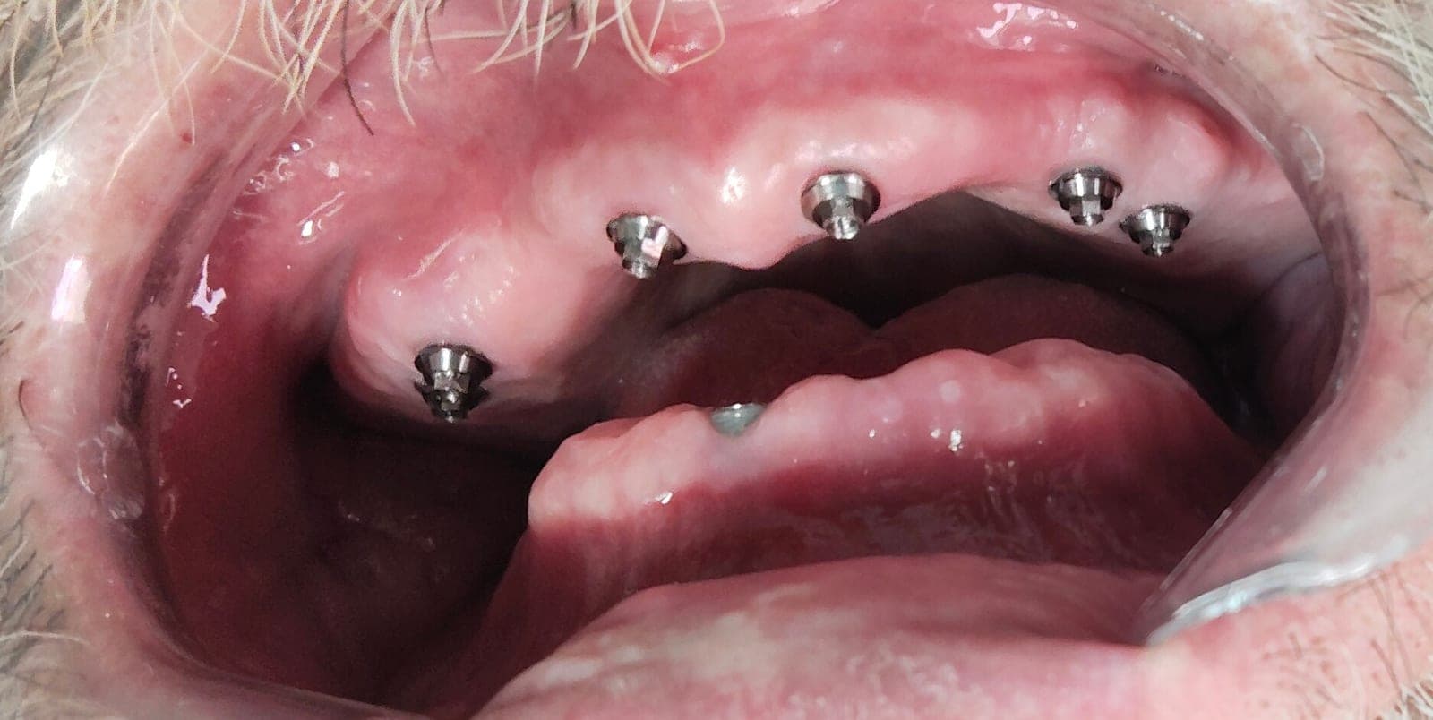 Implantes dentales de Carga Inmediata