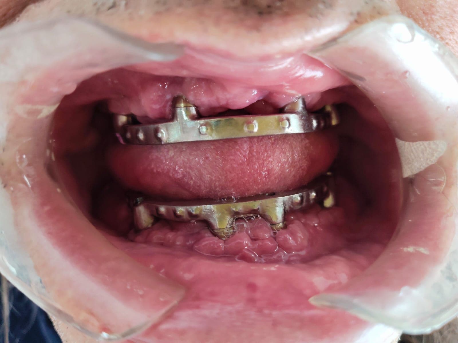 Rehabilitación Oral