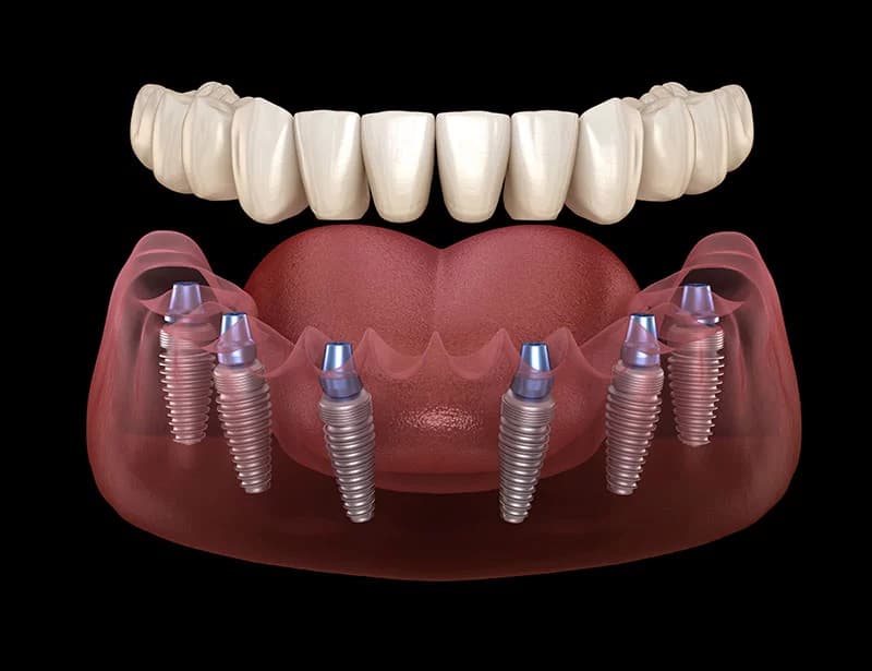 Implantes Dentales en Bogotá